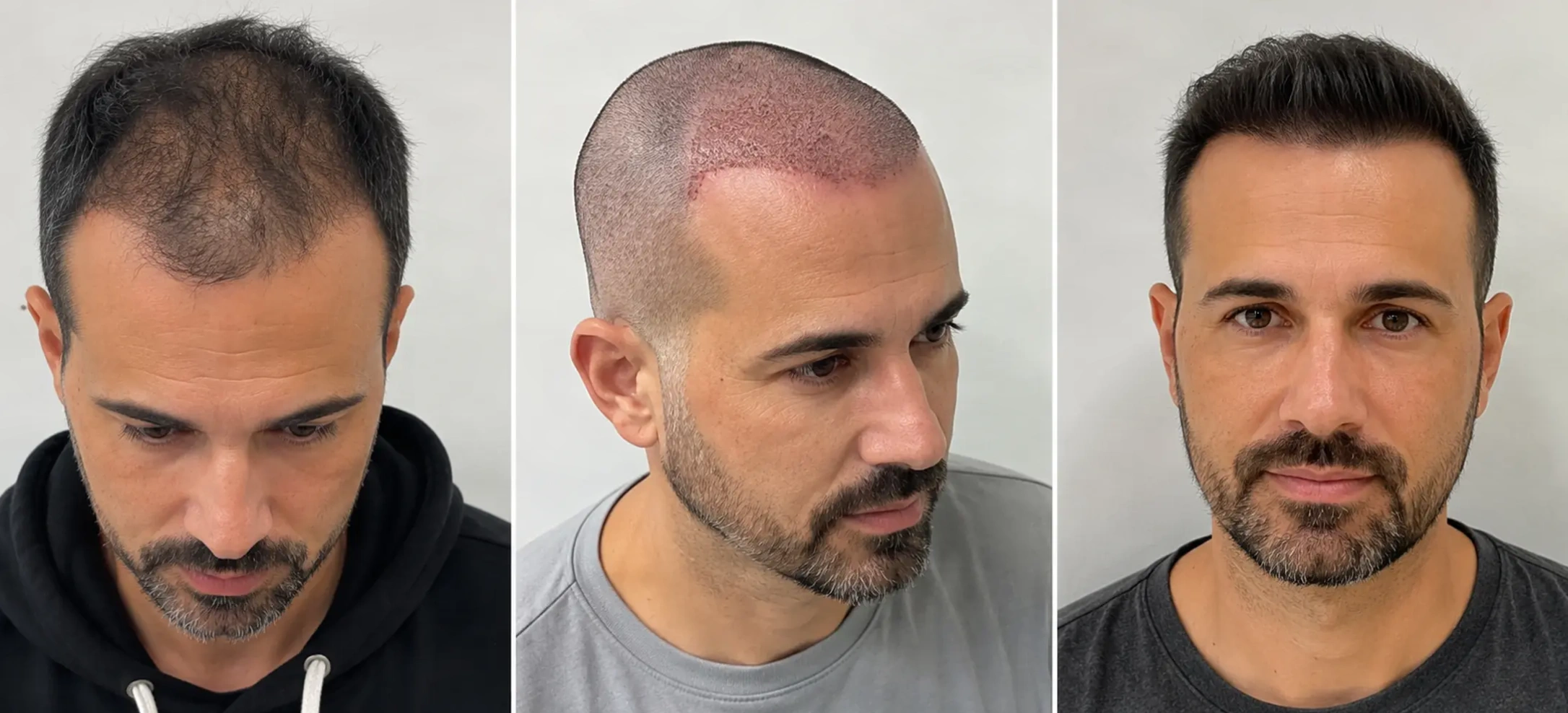 Trasplante capilar antes y después - Restauración natural de la línea frontal - Dr. Facundo Martínez Reynoso, Buenos Aires