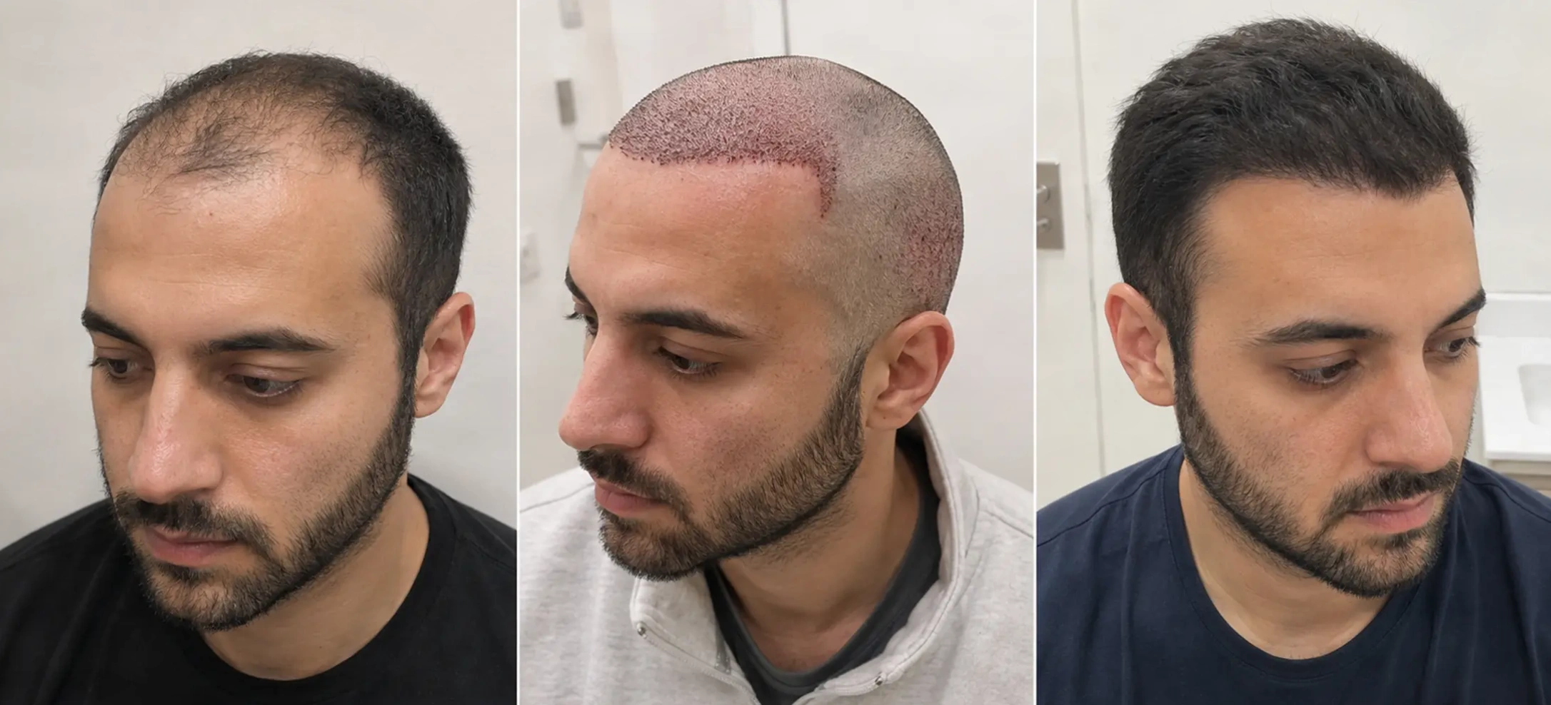 Trasplante capilar antes y después - Cobertura de entradas con técnica FUE - Dr. Facundo Martínez Reynoso, Buenos Aires